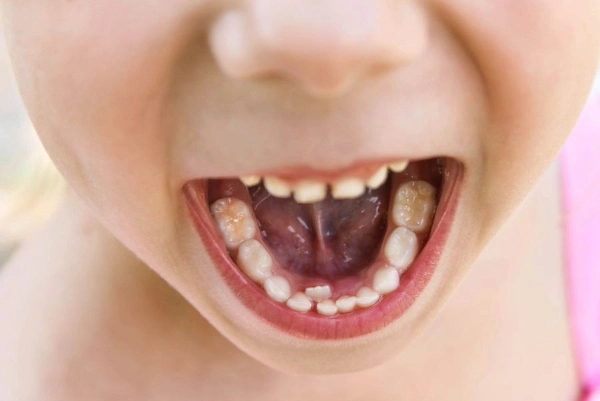 Caries en dientes de leche: por qué no deben ignorarse
