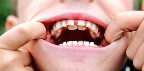 Cuándo llevar al niño al dentista por primera vez