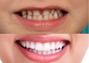 ¿Por qué es importante cuidar los dientes de leche